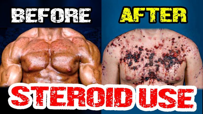 When Acne Strikes: The Skin Consequences Of Steroid Abuse