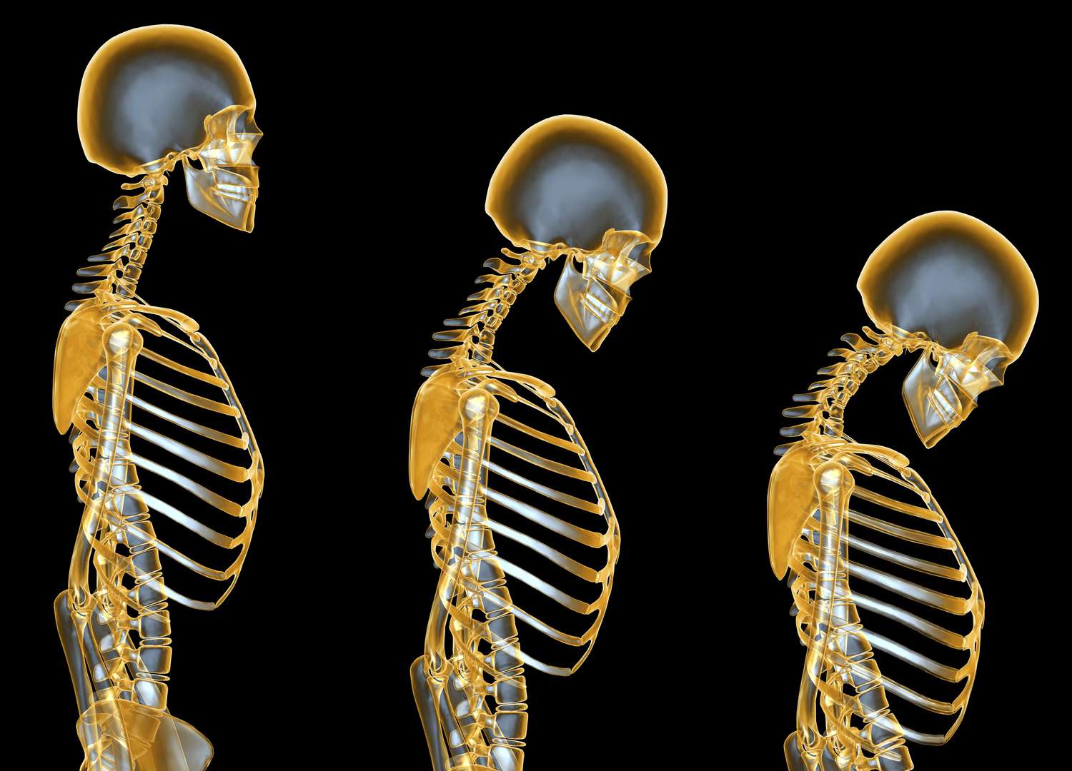 Fragile Bones: Osteoporosis and the Impact of Steroid Abuse